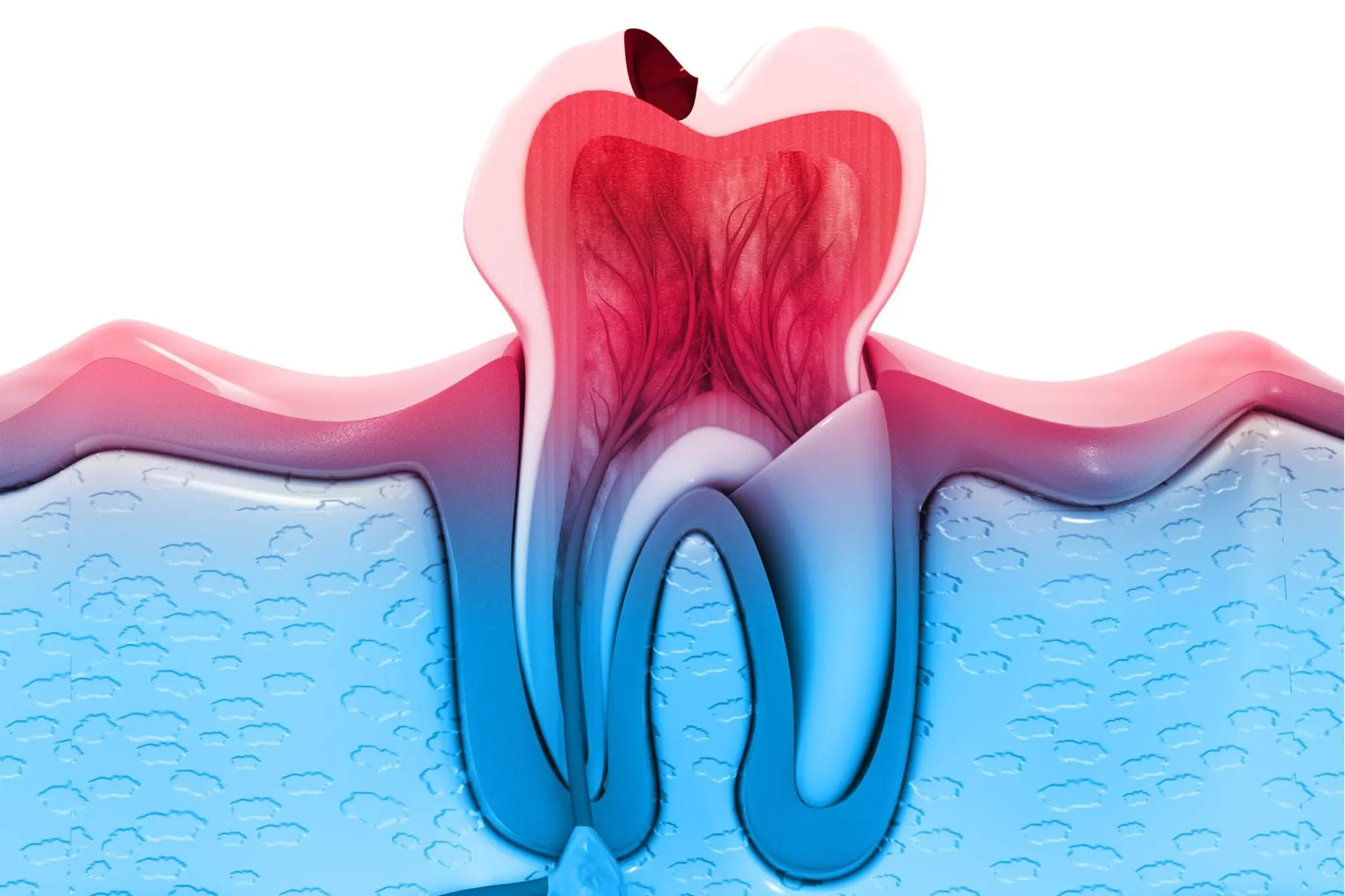 How Long Until a Tooth Infection Kills You 1