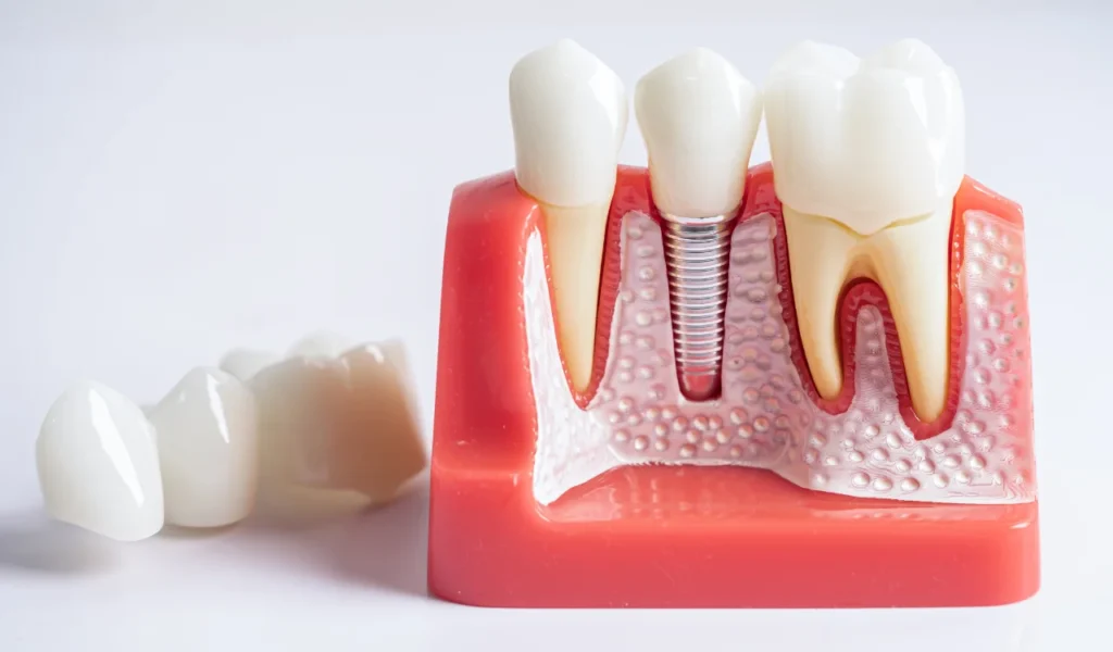 Understanding Root Canal Treatment