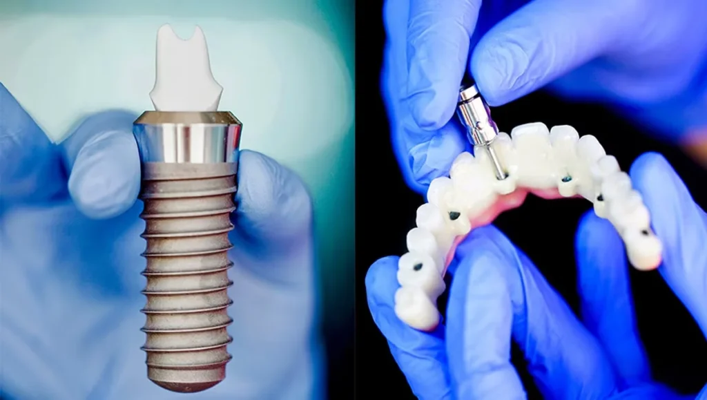 8 Signs Indicating the Need for Dental Implants