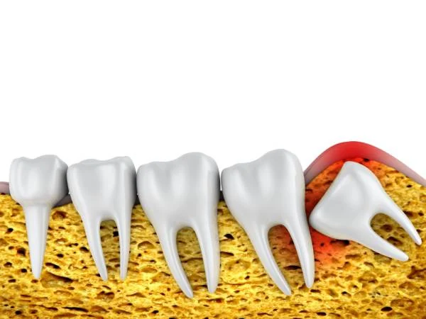 Understanding the Wisdom Tooth Extraction Recovery Timeline