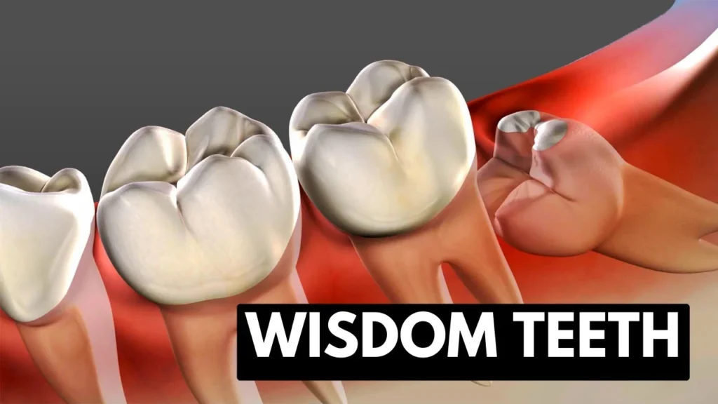 How Soon Can You Talk After Wisdom Teeth Removal? 3 How Soon Can You Talk After Wisdom Teeth Removal A Complete Guide