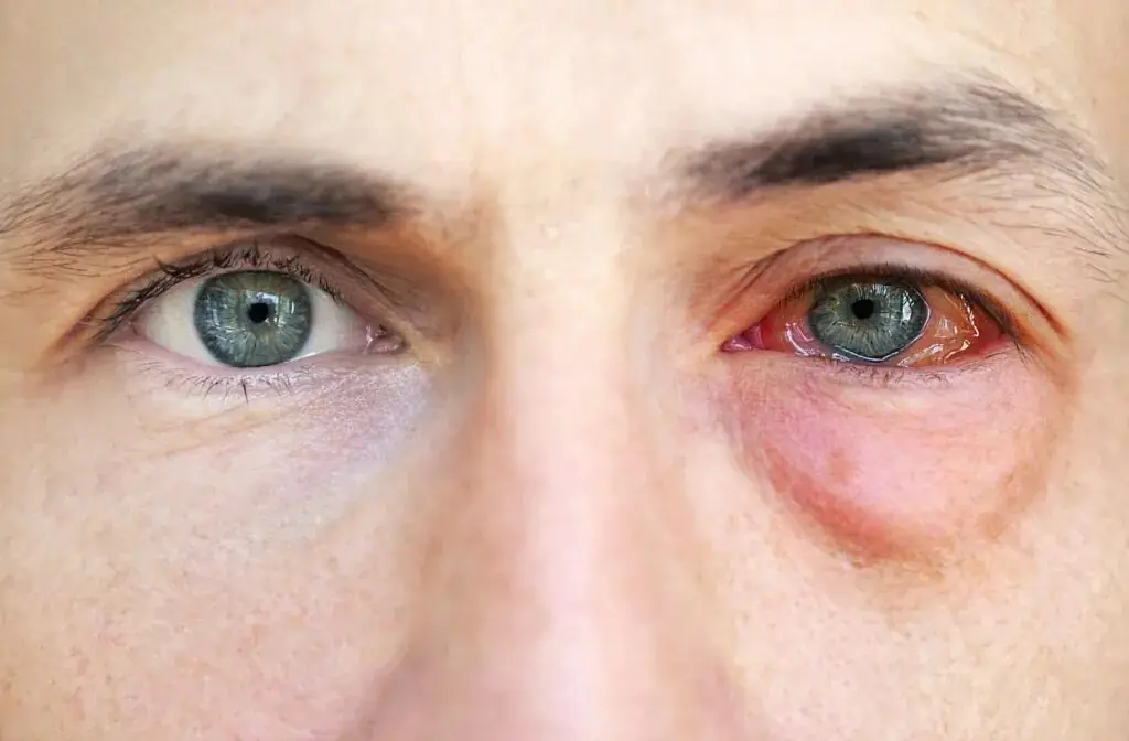 Pink Eye vs Stye: Causes, Differences, and Treatment Options 7 Allergic Conjunctivitis