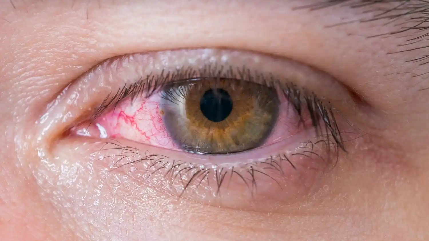 Pink Eye vs Stye: Causes, Differences, and Treatment Options 6 Bacterial Pink Eye