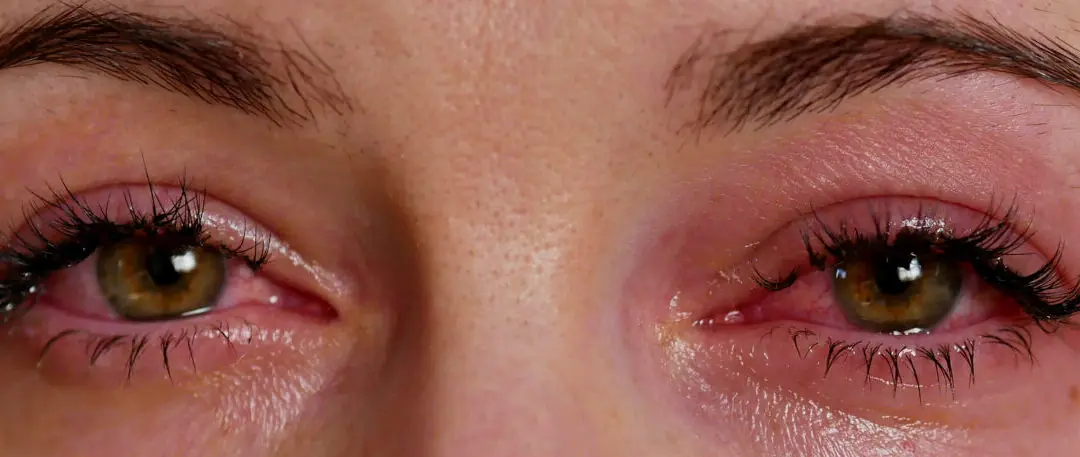 Pink Eye vs Stye: Causes, Differences, and Treatment Options 10 For Irritant Induced Pink Eye