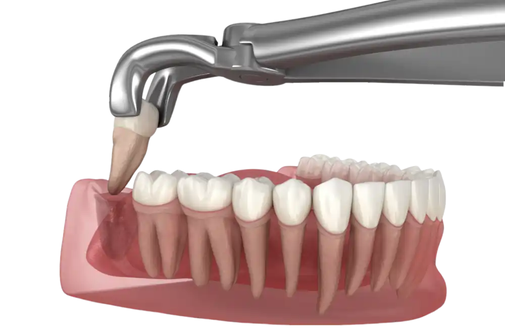 How Much Does It Cost to Remove Wisdom Teeth