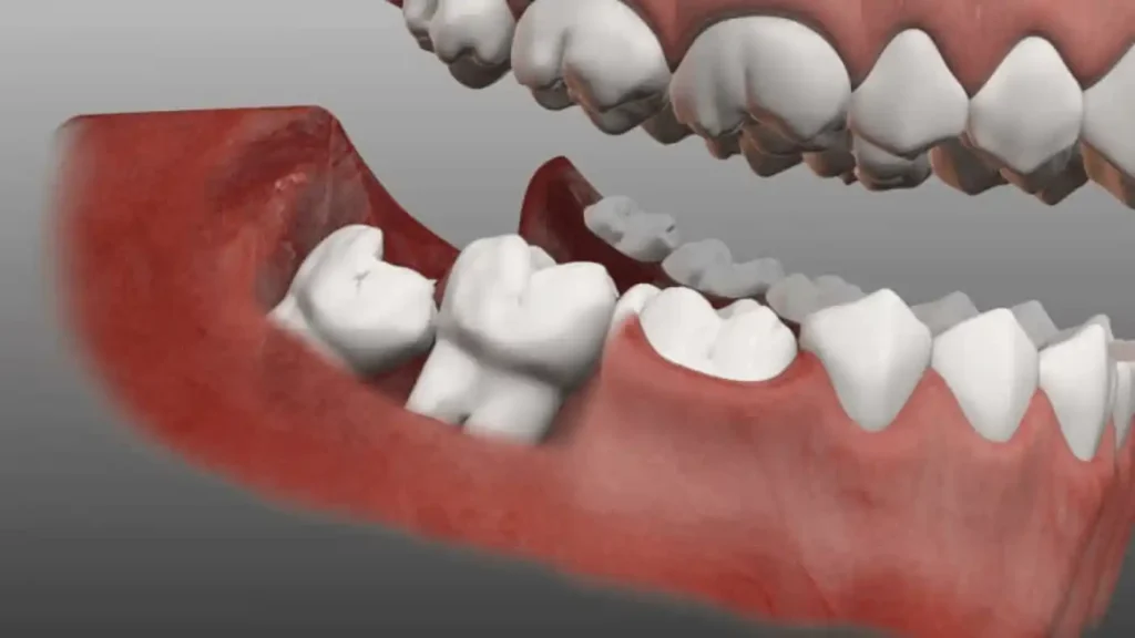 How Much Does It Cost to Remove Wisdom Teeth? 12+ Key Facts 10 How to Lower the Cost of Wisdom Tooth Extraction