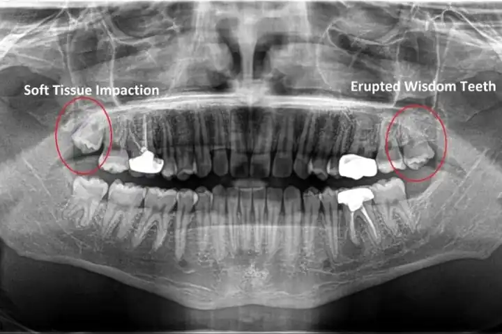 How Much Does It Cost to Remove Wisdom Teeth? 12+ Key Facts 6 Insurance Affects Wisdom Teeth Removal