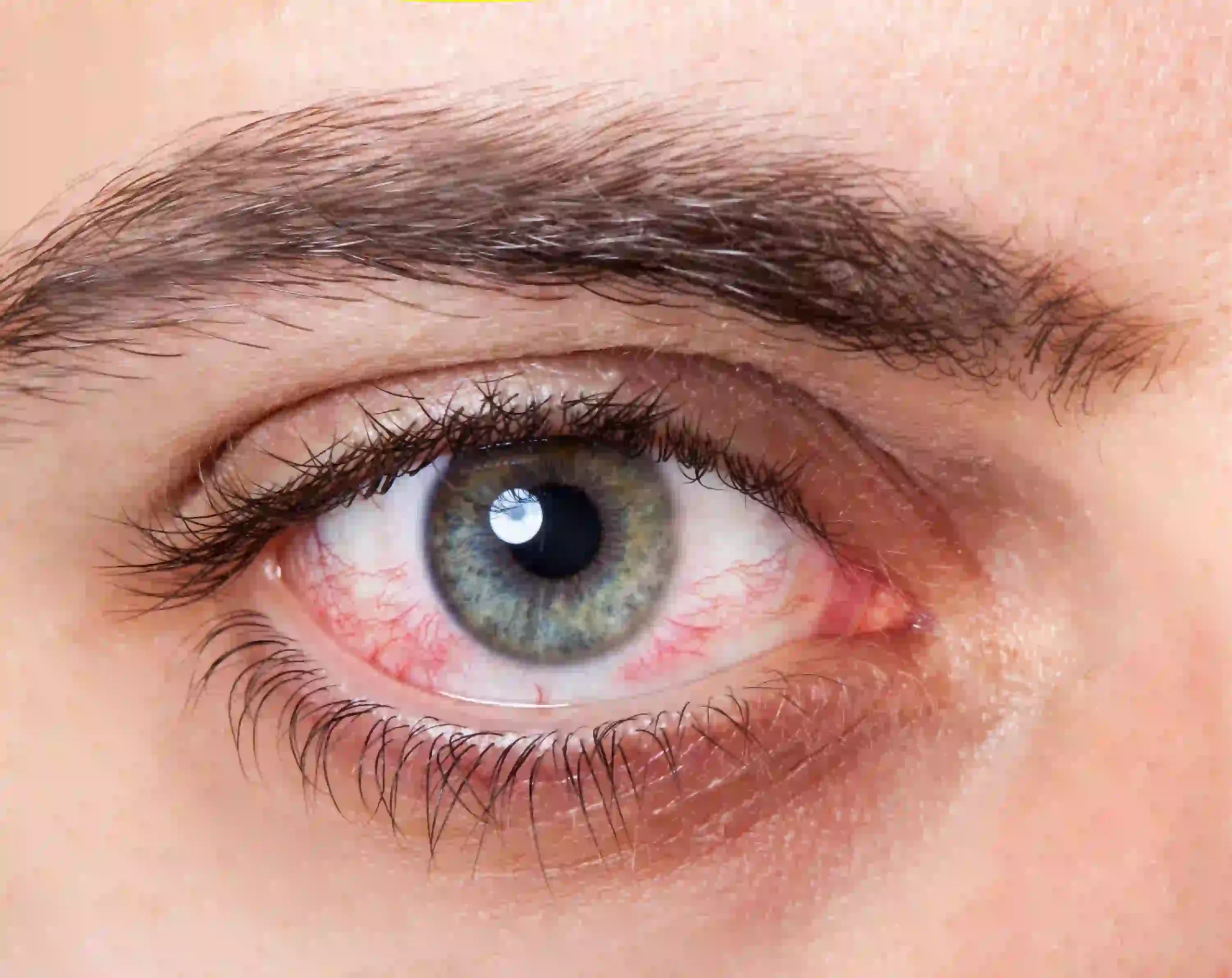 Pink Eye vs Stye: Causes, Differences, and Treatment Options 8 Irritant Conjunctivitis scaled