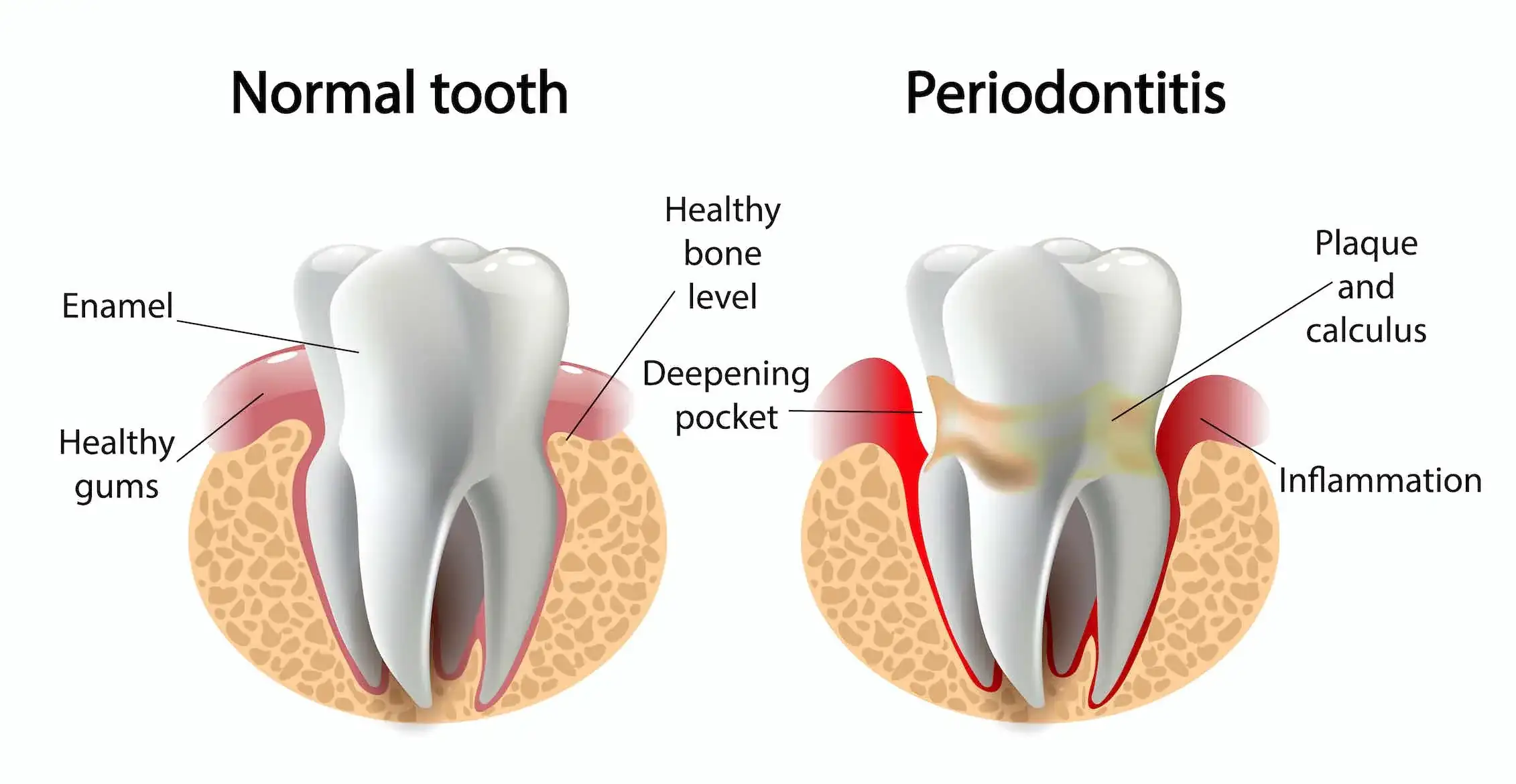 Is Periodontitis Reversible Top Tips and Treatment Options