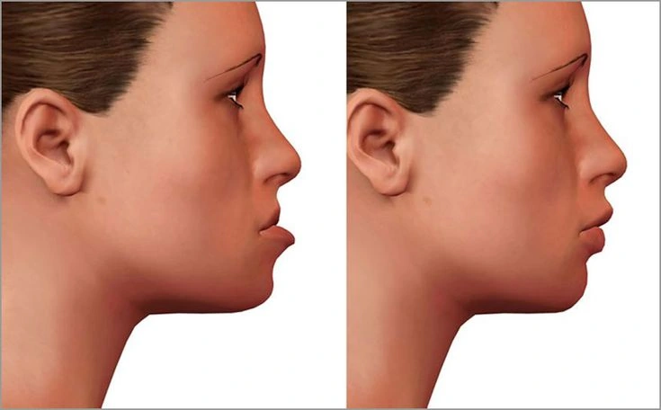 Jaw Stiffness