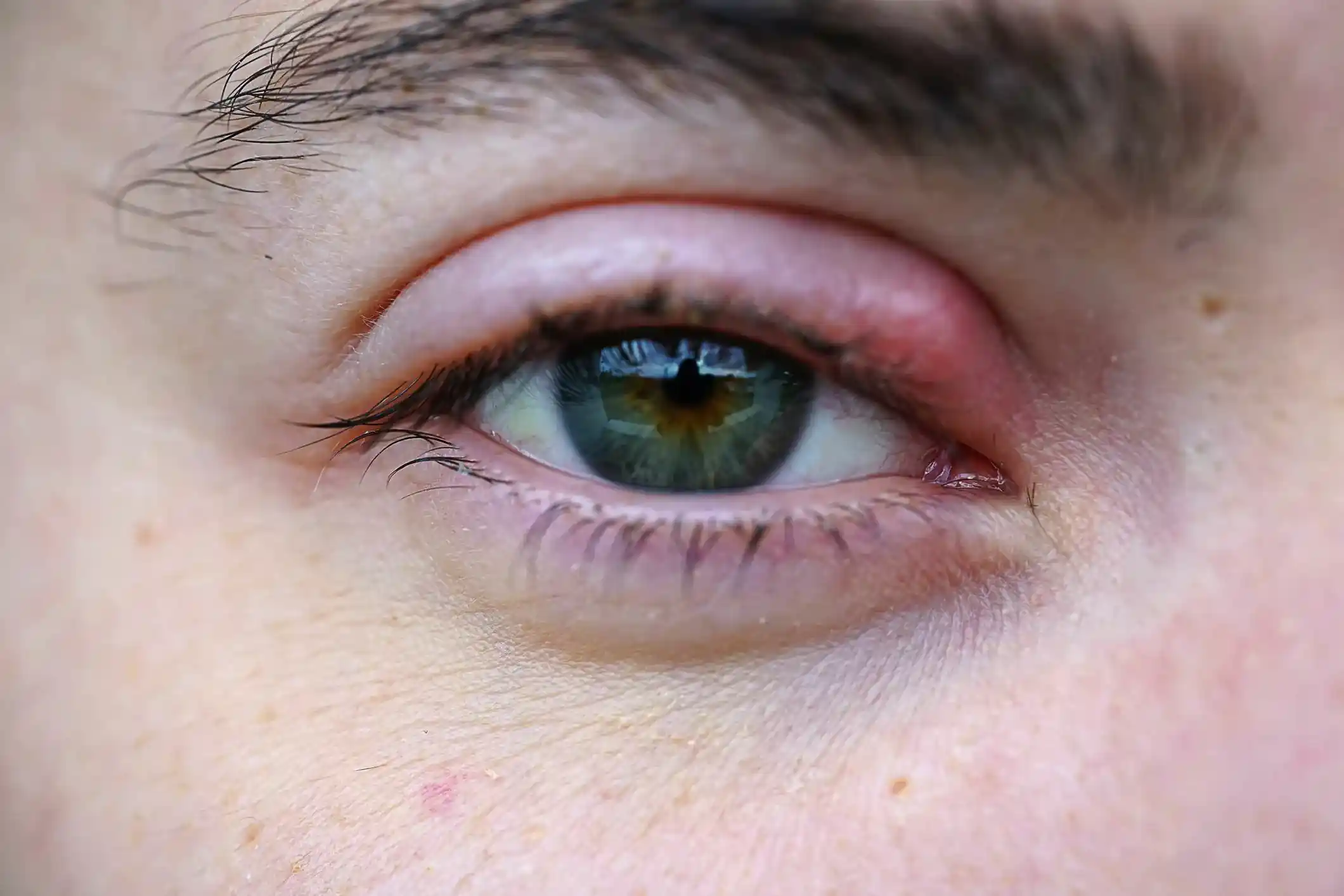 Pink Eye vs Stye: Causes, Differences, and Treatment Options 9 Stye and Pink Eye