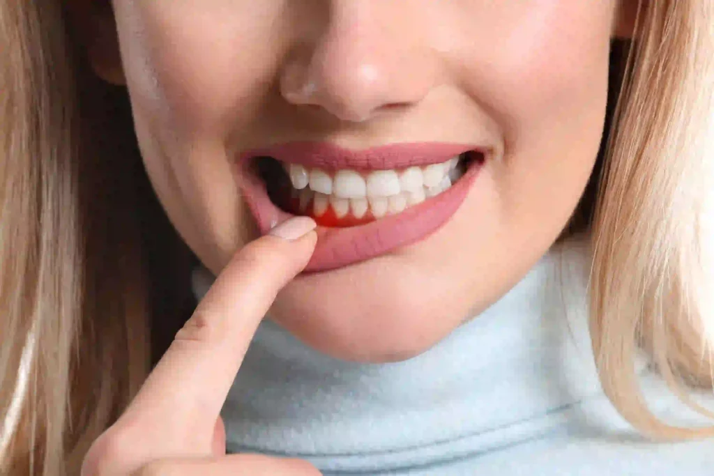 Swollen Gums or Sore Throat