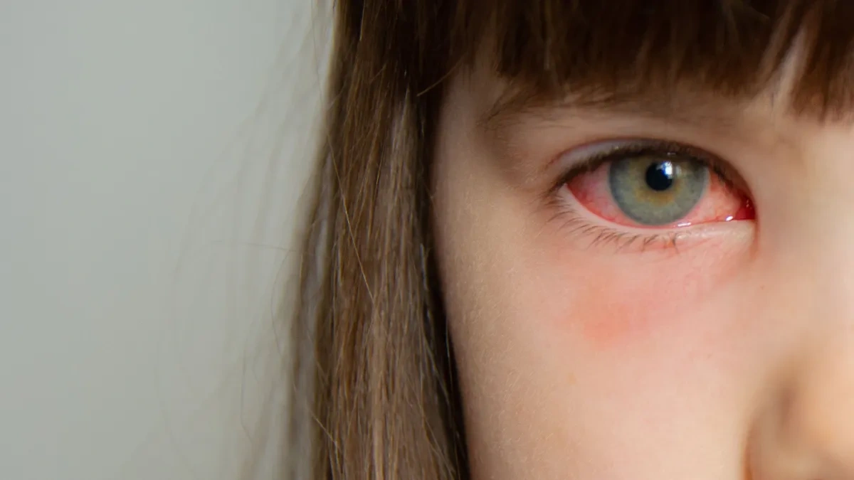 Pink Eye vs Stye: Causes, Differences, and Treatment Options 3 Understanding Pink Eye Conjunctivitis