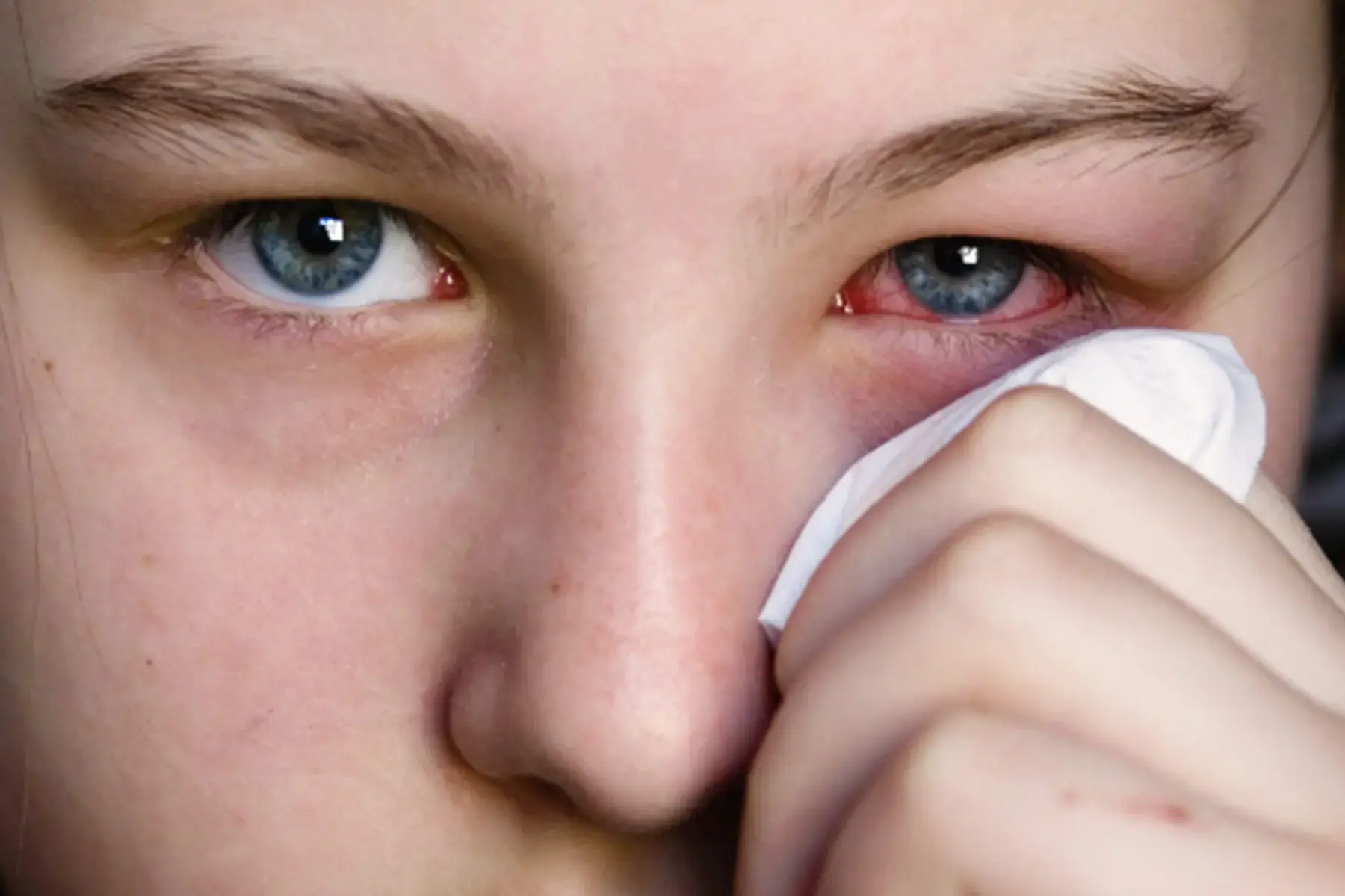Pink Eye vs Stye: Causes, Differences, and Treatment Options 5 Viral Pink Eye