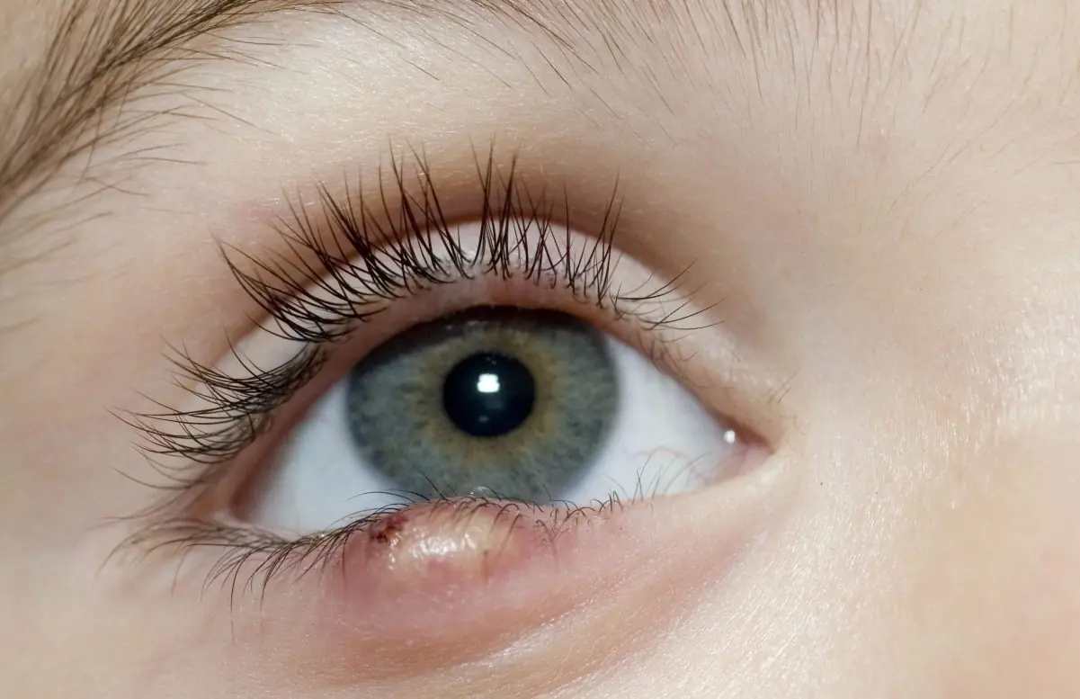 Pink Eye vs Stye: Causes, Differences, and Treatment Options 4 What is a Stye