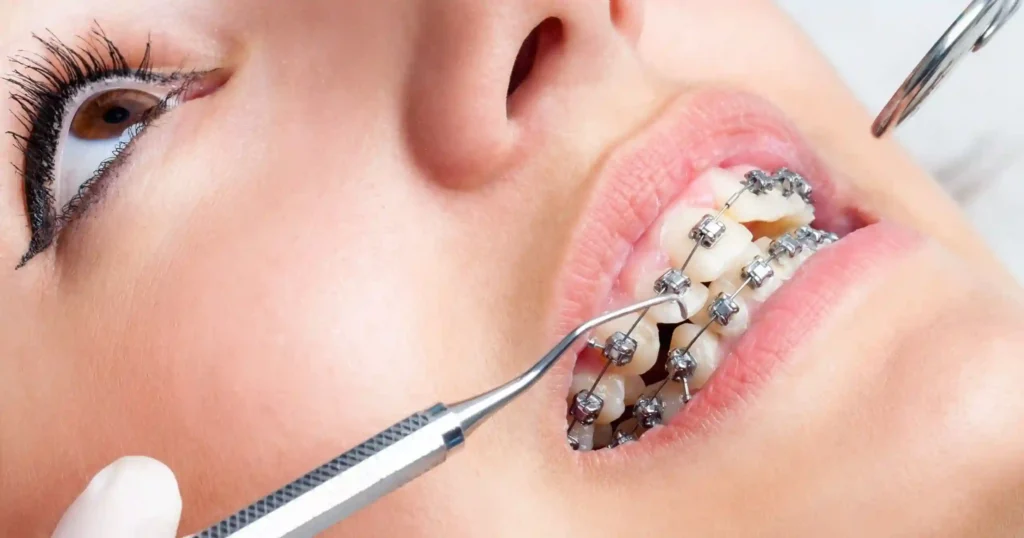 Alignment and Orthodontic Treatment