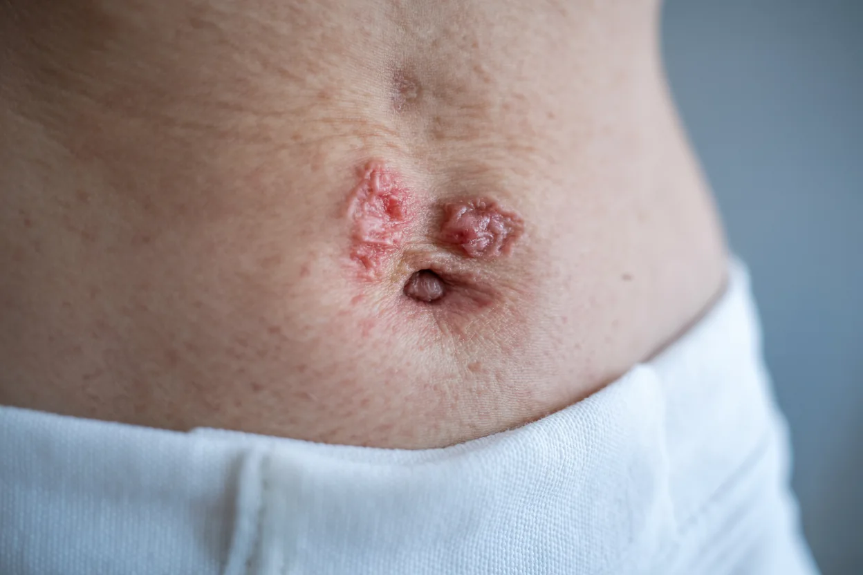 Can a Belly Button Infection Kill You Risks, Causes & Treatment