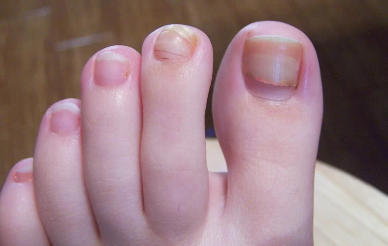 Changes in Nail Texture Appearance
