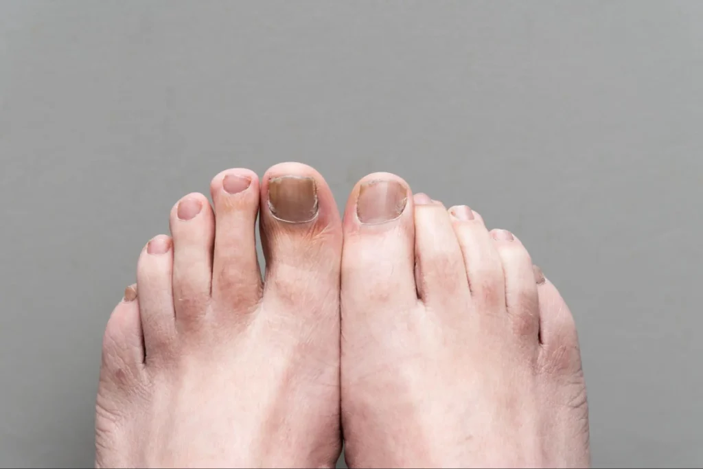 How Long Does It Take for Toenail Fungus to Die