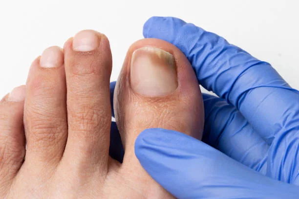 How to Know If Toenail Fungus Is Dying