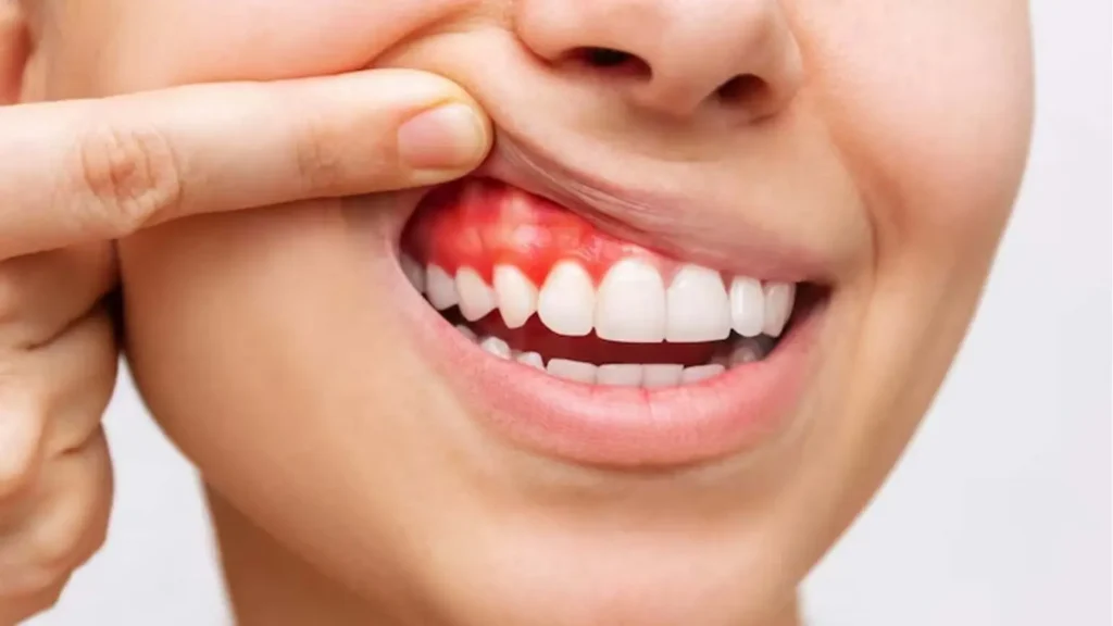 Infection or Gum Disease