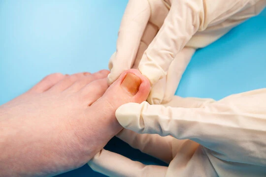 Preventing Reinfection After Recovery