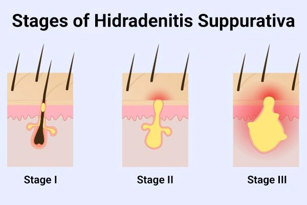 Can Hidradenitis Suppurativa Kill You? Risks, Causes & Treatment 5 The Hurley Stages of Hidradenitis Suppurativa