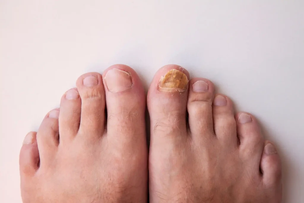 Understanding How to Know If Toenail Fungus Is Dying