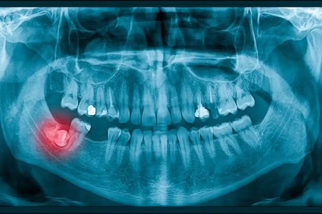 When Do Wisdom Teeth Begin to Grow