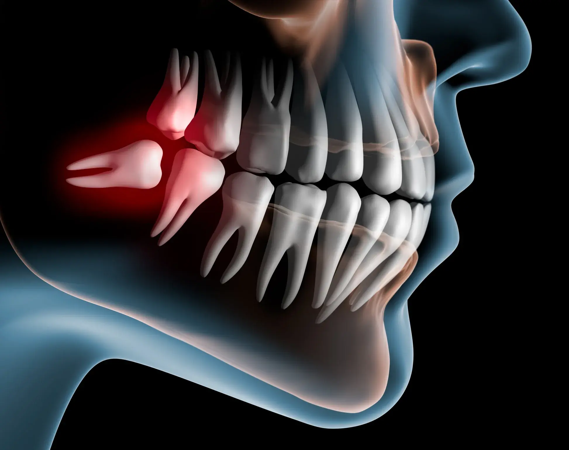 when Do Wisdom Teeth Stop Growing 10 Key Timelines & What to Expect