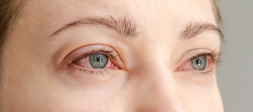 Allergies and Irritants