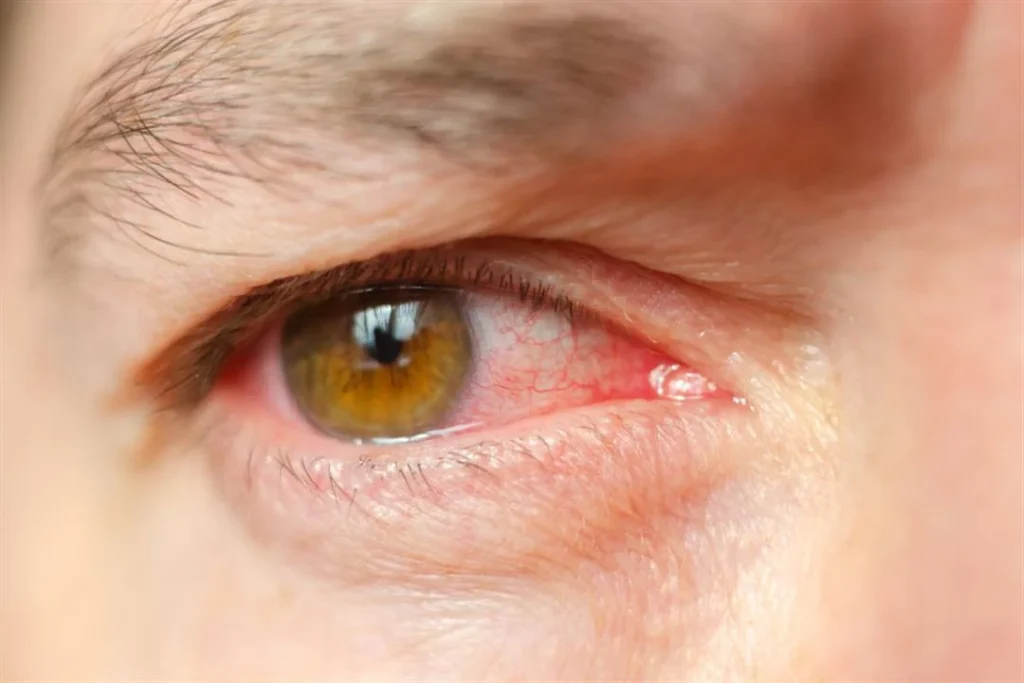 Conjunctivitis Pink Eye