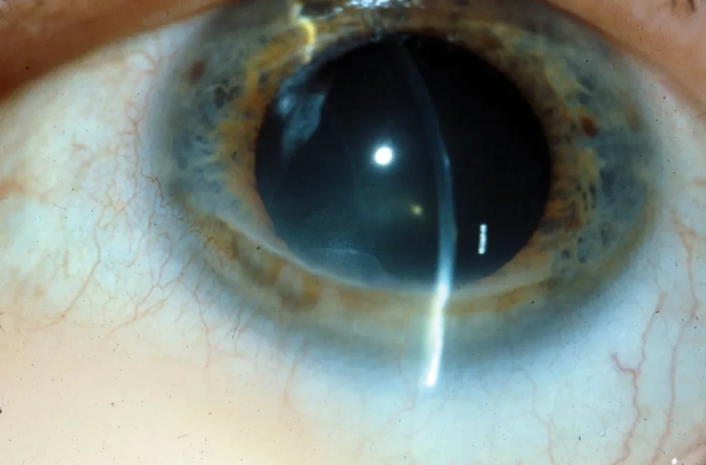 Corneal Issues Scratches or Ulcers