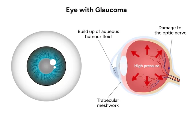 Glaucoma or Eye Pressure Disorders