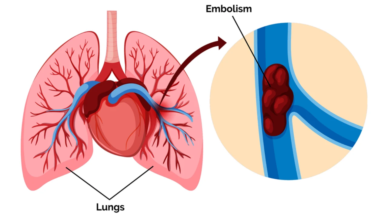 How Long Before a Pulmonary Embolism Kills You Explained