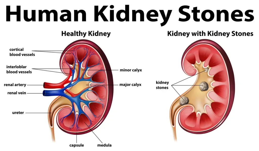 15 key Reasons for Burning Tip of Urethra No STD 5 Kidney Stones and Urinary Crystals