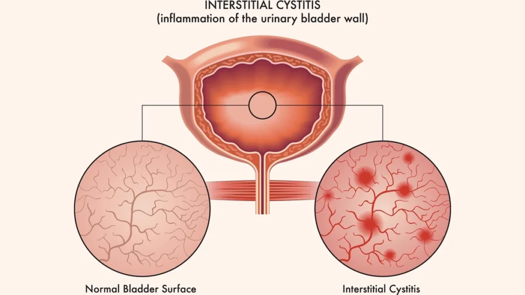 15 key Reasons for Burning Tip of Urethra No STD 8 Overactive Bladder Interstitial Cystitis