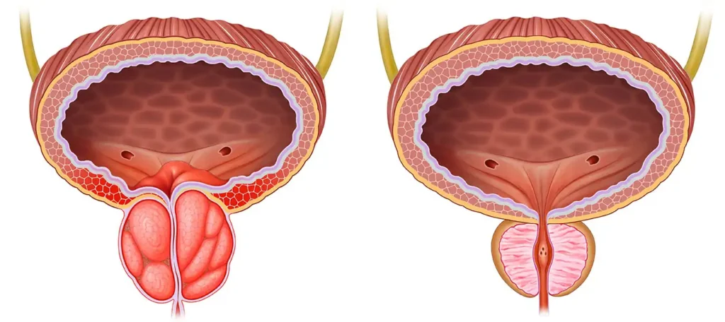 15 key Reasons for Burning Tip of Urethra No STD 7 Prostatitis Men Specific