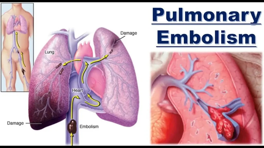 Pulmonary Embolism vs. Other Emergencies