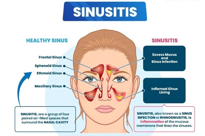 Sinus Infections and Pressure