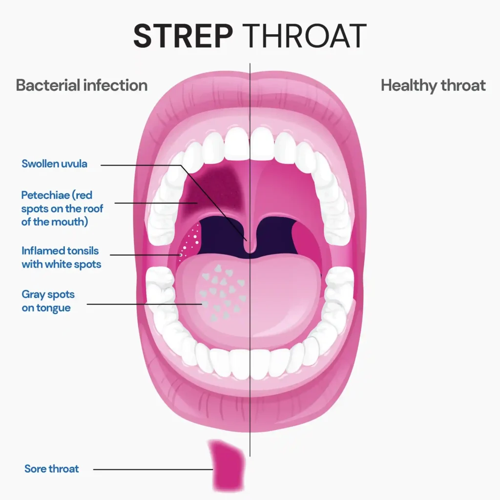 Strep Throat vs. Urinary Tract Infection