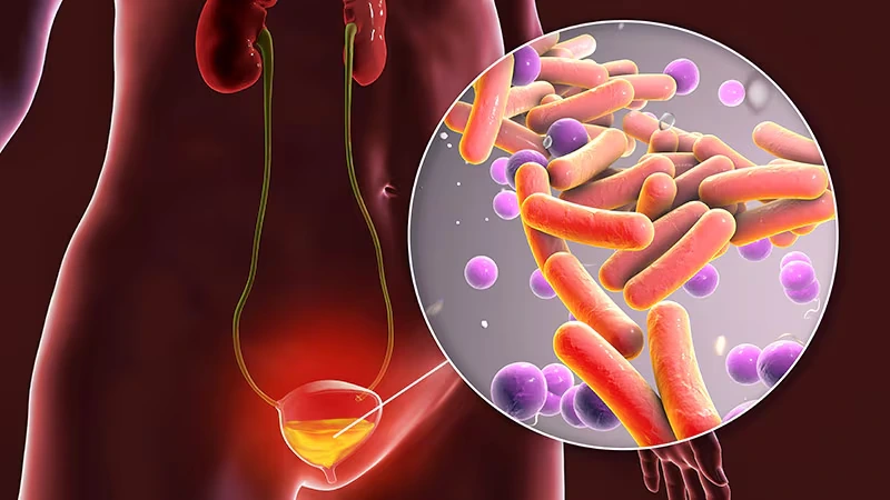 15 key Reasons for Burning Tip of Urethra No STD 3 Urinary Tract Infection UTI Without STD