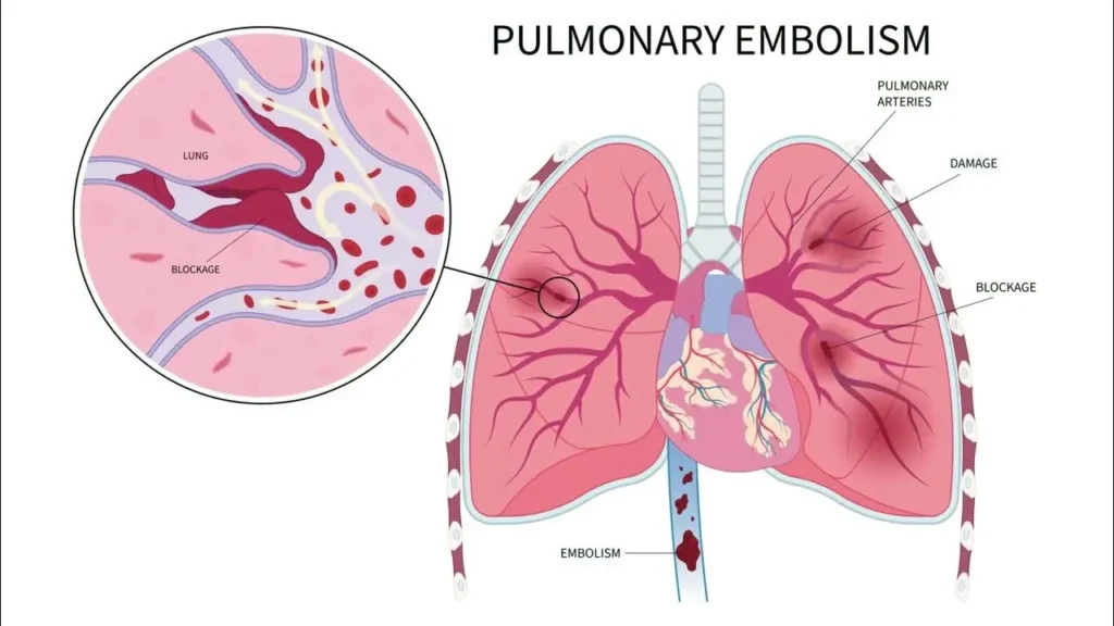 What Is a Pulmonary Embolism