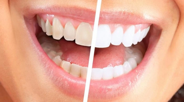 Whitens Teeth Naturally