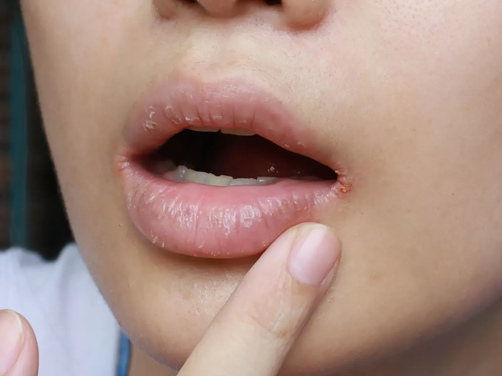 10 Fast Ways to Heal a Cold Sore Corner of Mouth 2 A close-up of a person’s lips with their mouth slightly open. A finger points to a small sore or cracked area at the corner of their mouth.