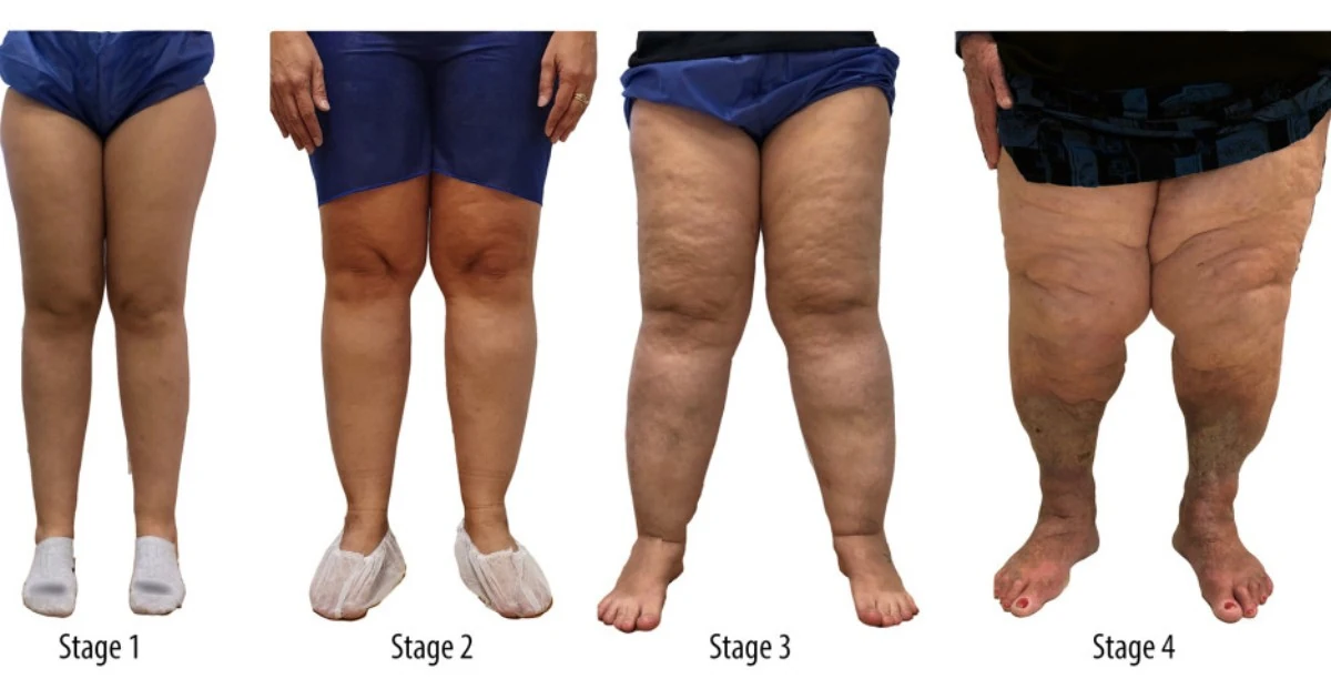 Four pairs of legs showing the progression of lipedema from stage 1 to stage 4, with increasing swelling, uneven fat distribution, and skin changes clearly visible at each stage.