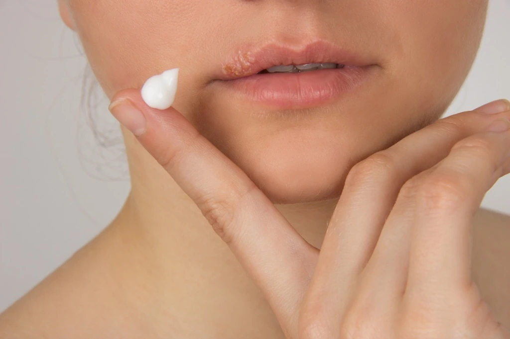 10 Fast Ways to Heal a Cold Sore Corner of Mouth 4 Apply an Antiviral Cream Immediately