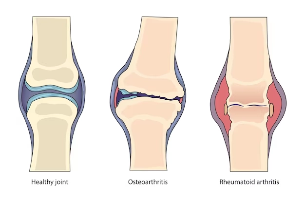 Why Does My Jaw Keep Locking? 12 Causes & Fixes 8 Arthritis Osteoarthritis Rheumatoid Arthritis