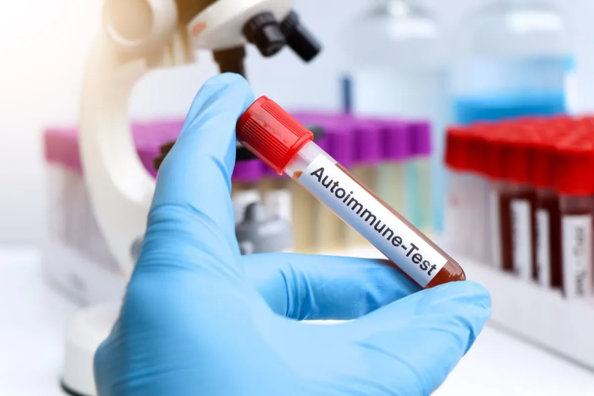 Sudden Bulging Veins in Hands With Pain: 10 causes 12 Blood Tests for Inflammation or Autoimmune Clues