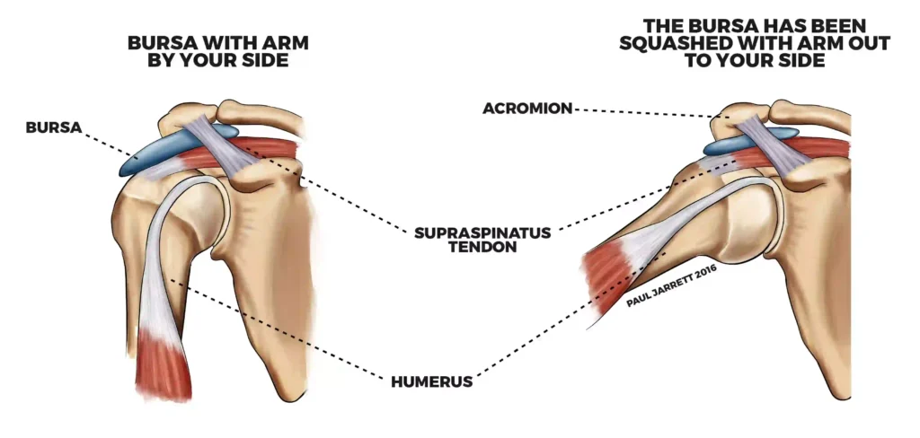 10 Causes of Pain in Upper Right Arm Between Elbow & Shoulder 8 Bursitis Shoulder or Upper Arm